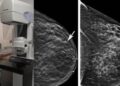La Arrixaca reduce de más de 40 días a menos de una hora el diagnóstico completo ante una sospecha de cáncer de mama