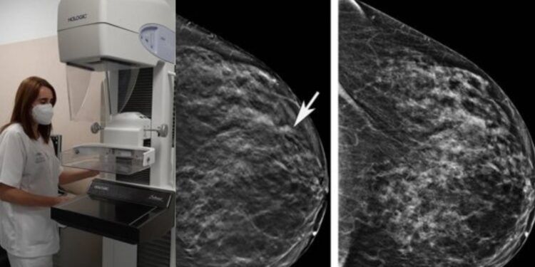 La Arrixaca reduce de más de 40 días a menos de una hora el diagnóstico completo ante una sospecha de cáncer de mama